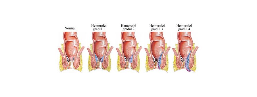 Ce Sunt Hemoroizii Hemoroizi Tratament Naturist Cauze Simptome